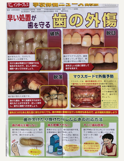 学校保健ニュース 歯の外傷について 院長ブログ まきの歯科医院 富山県高岡市