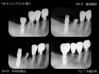 根分岐部病変２度：失活歯＋ブラキシズム 院長ブログ - まきの歯科医院 | 富山県高岡市