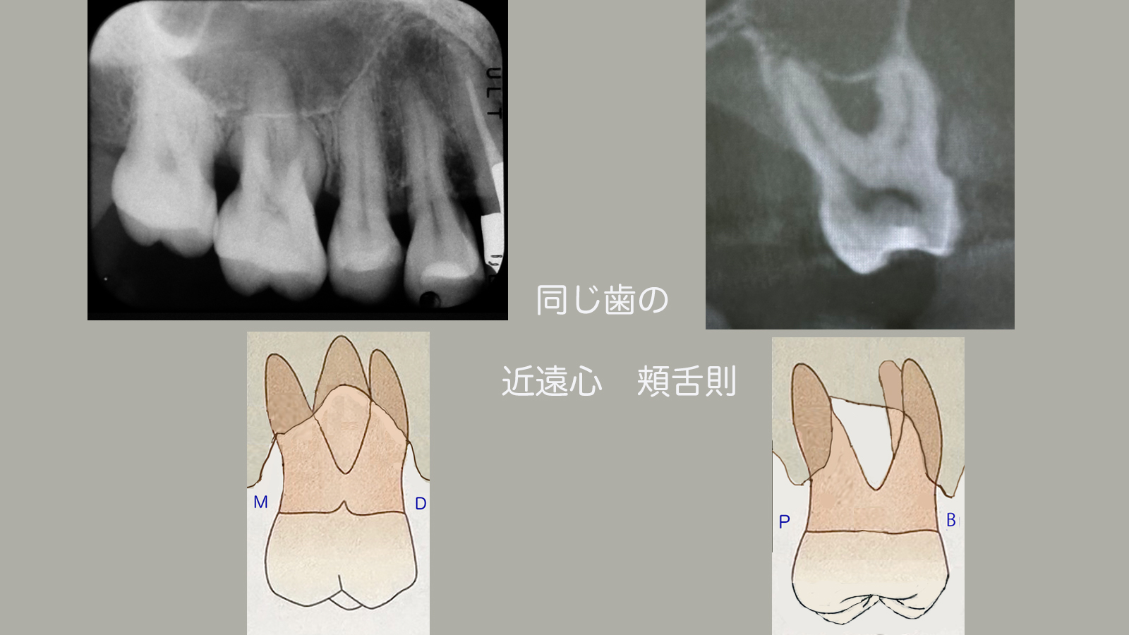 https://www.makino418.com/blog/2024/07/27/%E6%A0%B9%E5%88%86%E5%B2%90%E9%83%A8%E3%81%AEB~Ppsd.jpg